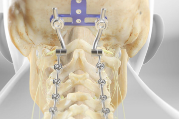 Occipitocervical Fusion