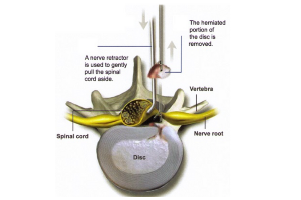 Lumbar Microdiscectomy