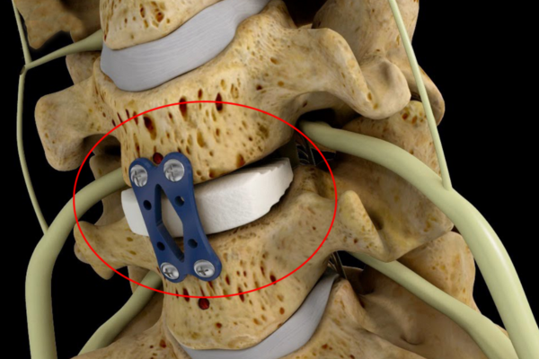 Anterior Cervical Spine Surgery