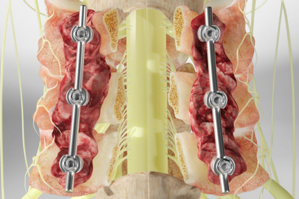 Posterior Cervical Spine Surgery