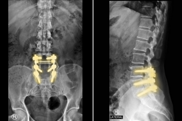 Lumbar Spinal Fusion